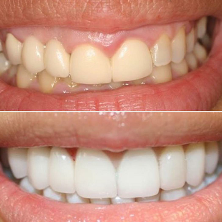 CARILLAS DENTALES